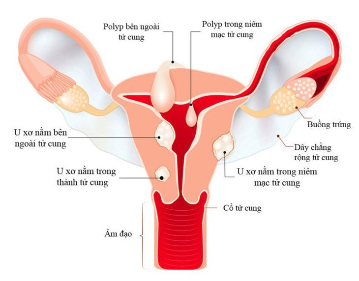 U xơ tử cung là gì? - Bệnh viện Hùng Vương