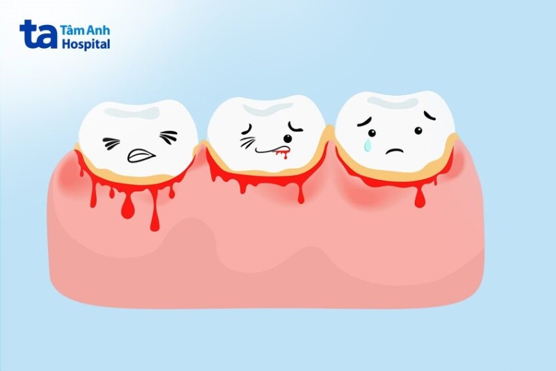 Chảy máu chân răng: Nguyên nhân, cách chữa trị và phòng ngừa