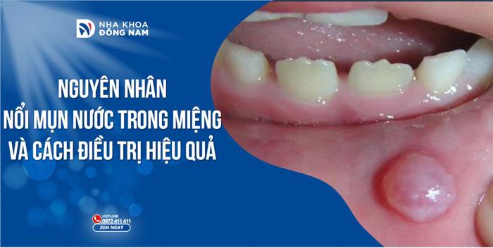 Nguyên nhân nổi mụn nước trong miệng và cách điều trị hiệu quả