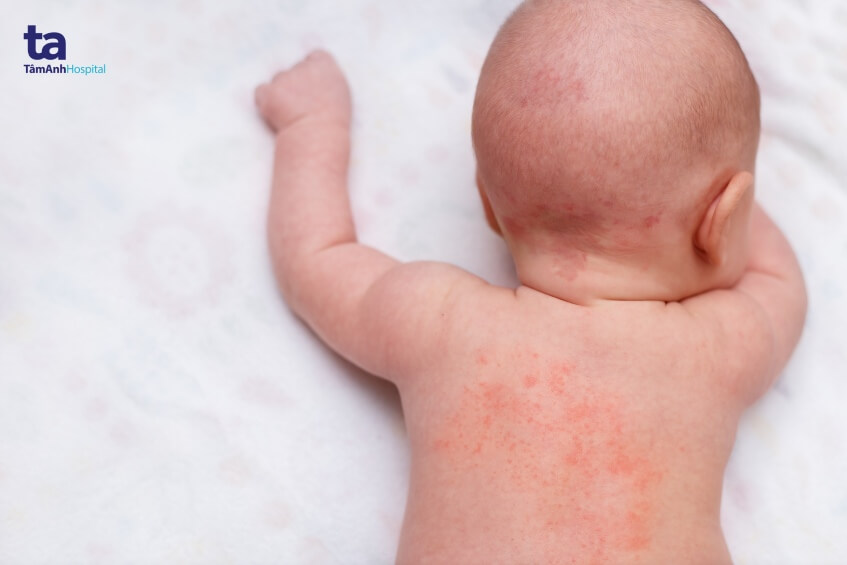 Bệnh chàm (Eczema): Dấu hiệu, nguyên nhân, biến chứng và chẩn đoán