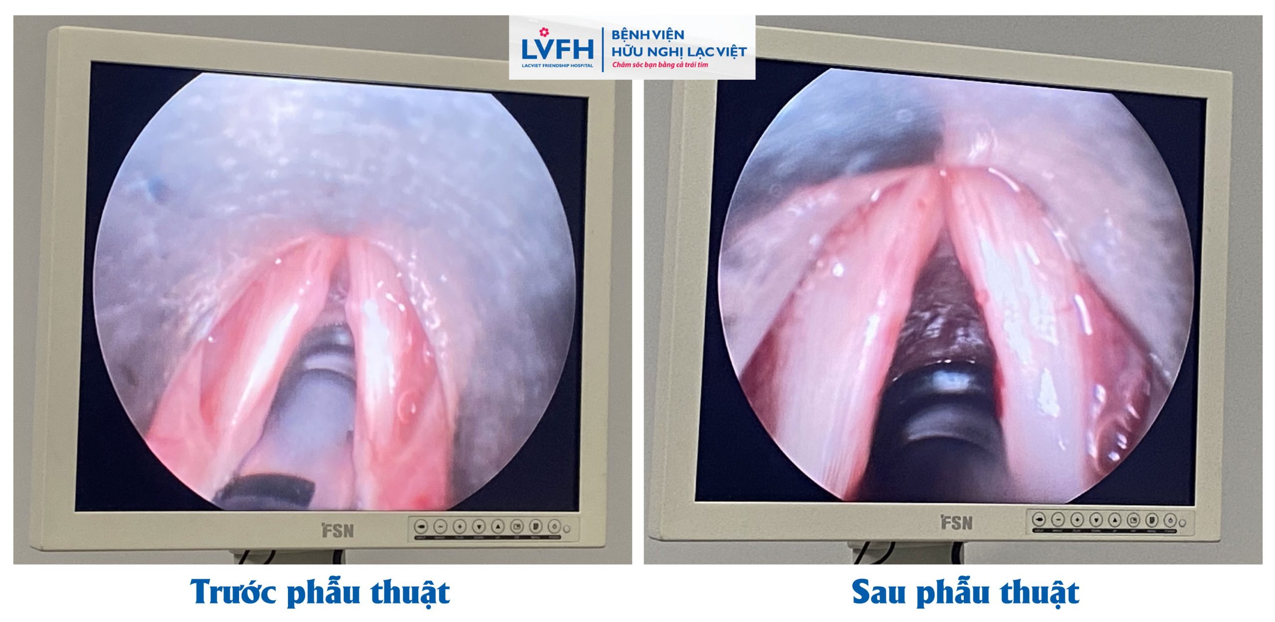 Phẫu thuật nội soi hạt xơ dây thanh quản Hiệu quả cao Ít xâm lấn