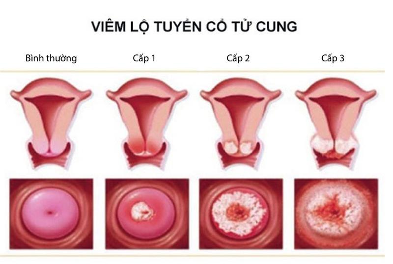 Viêm lộ tuyến độ 3 đặt thuốc có khỏi không và những cách điều trị