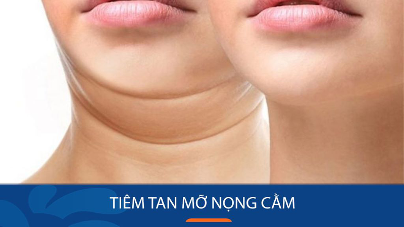 Phương pháp tiêm tan mỡ nọng cằm: Cơ chế, quá trình thực hiện và tác dụng phụ