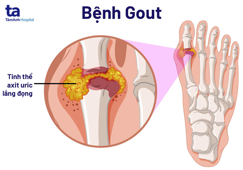 Đau khớp khuỷu tay: Nguyên nhân, chẩn đoán và điều trị