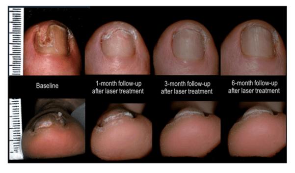 Các phương pháp điều trị bạch biến