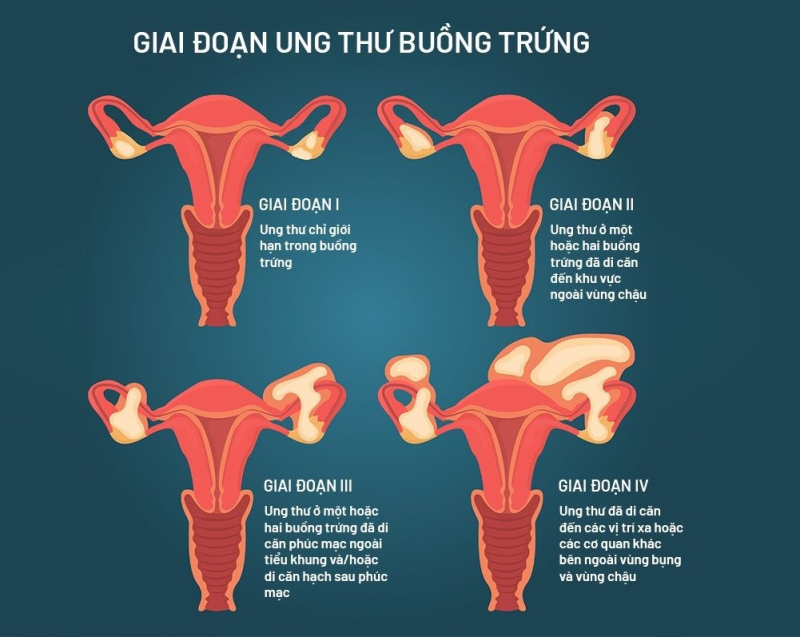 Ung thư buồng trứng: Nguyên nhân, triệu chứng và các phương pháp điều trị - Bệnh viện Bãi Cháy